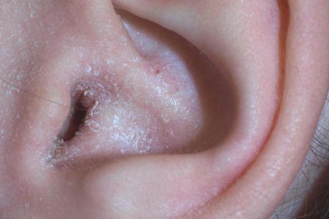 耳朵湿疹是什么原因造成的优质 耳朵湿疹把耳朵弄肿了怎么办